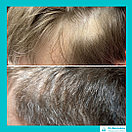 Лечение выпадения волос у мужчин, фото 3