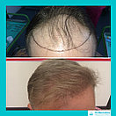 Лечение выпадения волос у мужчин, фото 10