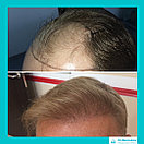 Лечение выпадения волос у мужчин, фото 9