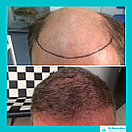 Лечение выпадения волос у мужчин, фото 6