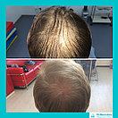 Лечение выпадения волос у мужчин, фото 7