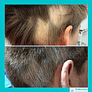 Лечение выпадения волос у мужчин, фото 4