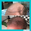 Лечение выпадения волос у мужчин, фото 5