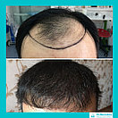 Пересадка волос в Алматы, фото 2