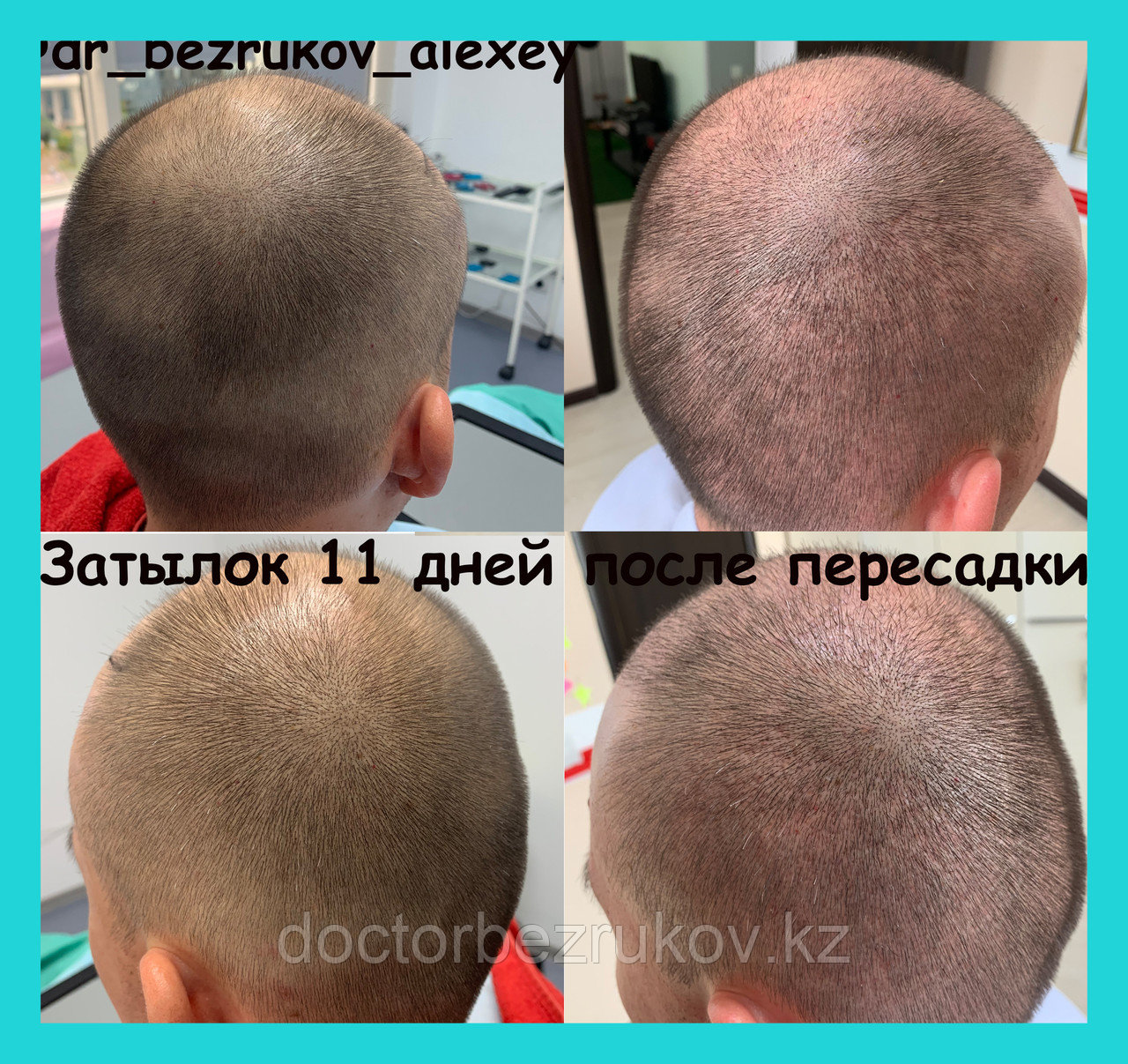 Пересадка волос в Алматы - фото 10 - id-p1430896
