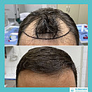 Пересадка волос методом фолликулярной экстракции в Алматы, фото 7