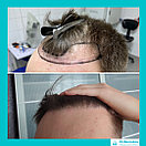 Пересадка волос методом фолликулярной экстракции в Алматы, фото 4