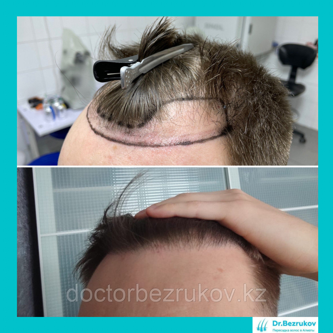 Пересадка волос методом фолликулярной экстракции в Алматы - фото 4 - id-p1445296