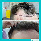 Пересадка волос методом фолликулярной экстракции в Алматы, фото 3