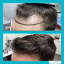 Пересадка волос методом фолликулярной экстракции в Алматы, фото 9