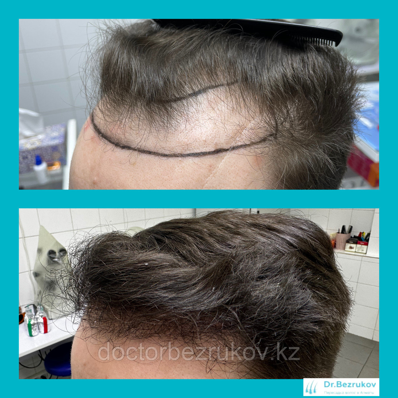 Пересадка волос методом фолликулярной экстракции в Алматы - фото 9 - id-p1445296