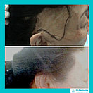 Безоперационная пересадка волос метод FUE в Алмате, фото 5