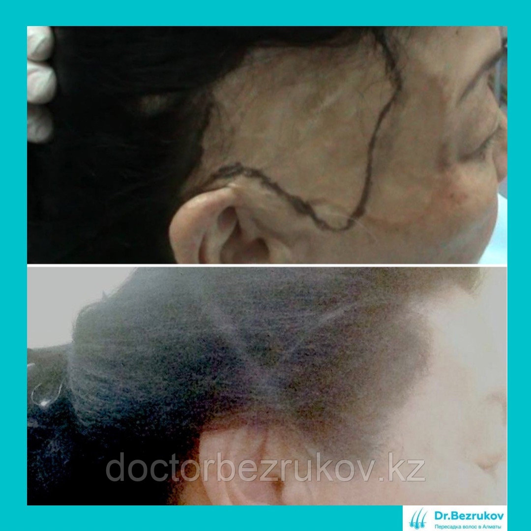 Безоперационная пересадка волос метод FUE в Алмате - фото 5 - id-p1743227