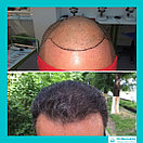 Безоперационная пересадка волос метод FUE в Алмате, фото 7