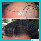 Безоперационная пересадка волос метод FUE в Алмате, фото 6