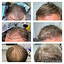 Безоперационная пересадка волос метод FUE в Алмате, фото 9