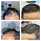 Безоперационная пересадка волос метод FUE в Алмате, фото 8