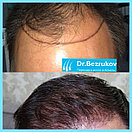 Безоперационная пересадка волос метод FUE в Алмате, фото 2