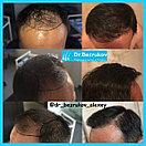 Безоперационная пересадка волос метод FUE в Алмате, фото 3