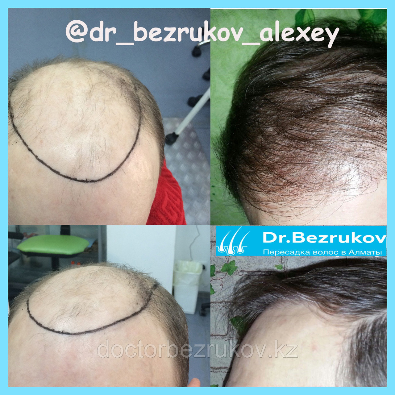 Безоперационная пересадка волос метод FUE в Алмате