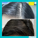 Бесшрамовая операция по пересадке волос в Алмате, фото 7