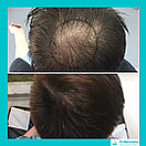 Бесшрамовая операция по пересадке волос в Алмате, фото 6