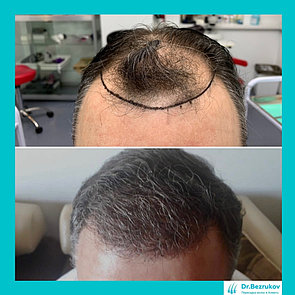 Бесшрамовая операция по пересадке волос в Алмате