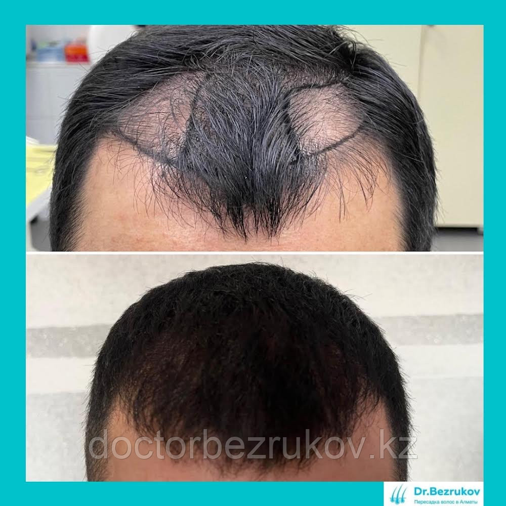 Восстановление волос, пересадка волос - фото 4 - id-p1008523
