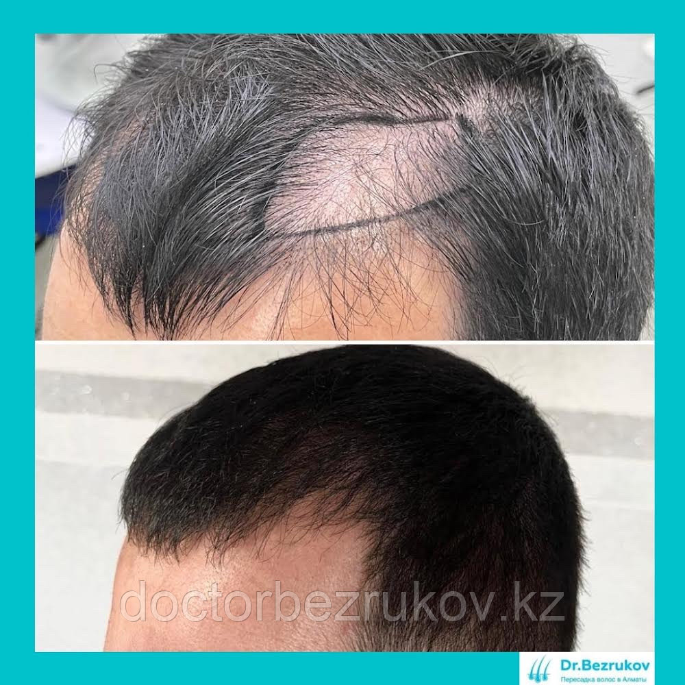 Восстановление волос, пересадка волос - фото 5 - id-p1008523