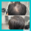 Восстановление волос, пересадка волос, фото 7
