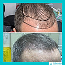 Восстановление волос, пересадка волос, фото 9