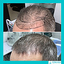 Восстановление волос, пересадка волос, фото 10