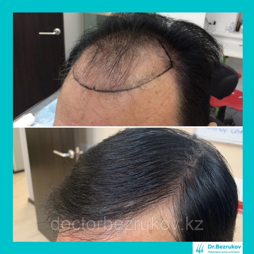 Трансплантация волос Алматы - фото 10 - id-p1015347