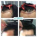 Трансплантация волос Алматы, фото 2