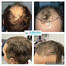 Трансплантация волос Алматы, фото 3