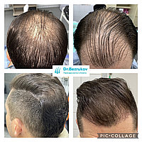 Трансплантация волос Алматы