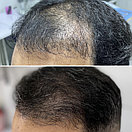 Трансплантация волос Алматы, фото 8