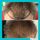 Рубцовая алопеция, пересадка волос, фото 4