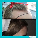 Рубцовая алопеция, пересадка волос, фото 3