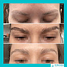 Пересадка бровей в Алматы, фото 5