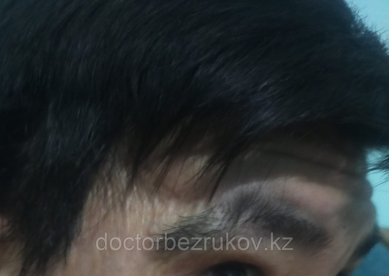 Трансплантация волос в область бровей - фото 2 - id-p1743254