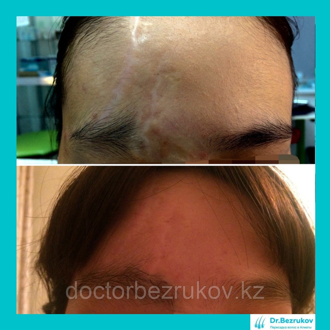 Трансплантация волос в область бровей - фото 3 - id-p1743254