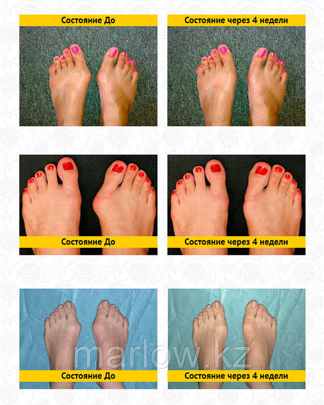 Какие бывают пальцы ног. Расположение пальцев на стопе. Нормальная форма пальцев на ногах. Правильное расположение пальцев на ногах. Правильное положение пальцев стопы.