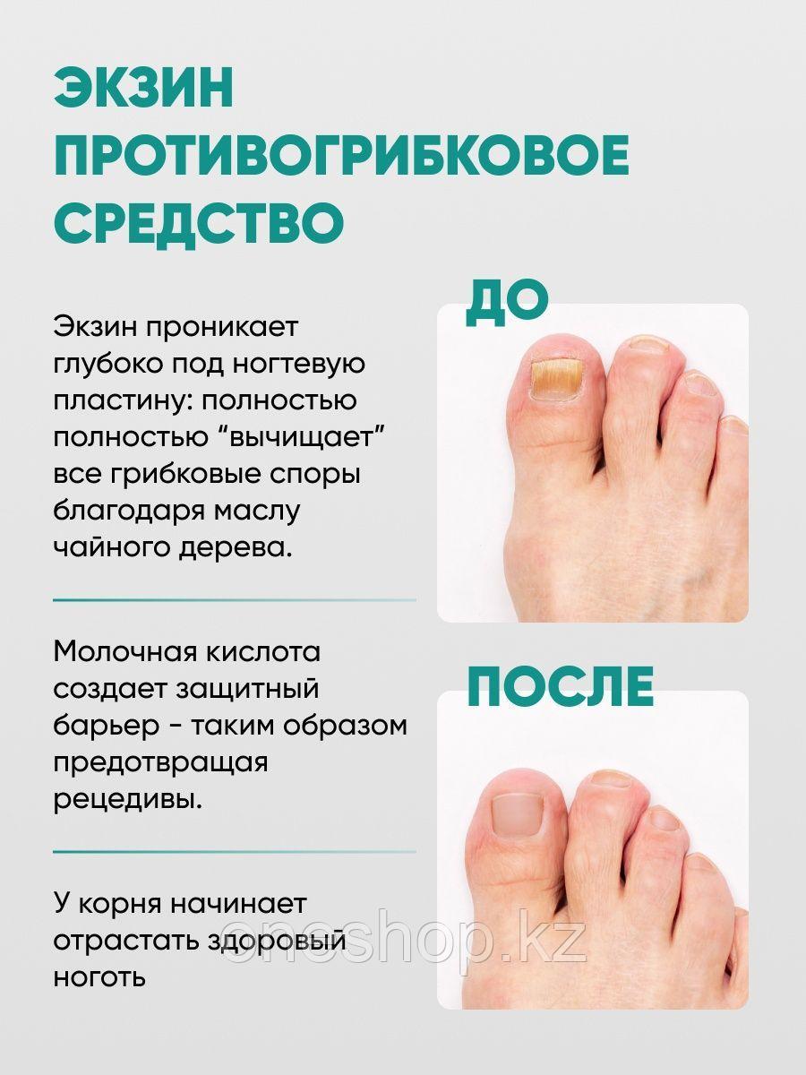 Крем Экзин Где Купить