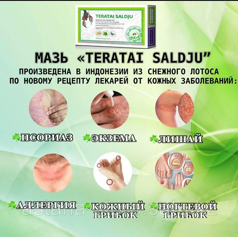 Мазь Teratai Saldju против псориаза, экземы, лишая, кожного грибка, ногтевого грибка и аллергии - фото 2 - id-p108416523