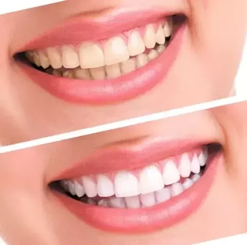 Набор для отбеливания зубов электрический Spin Smile 360 Professional Grade Tooth Polisher - фото 7 - id-p110895252