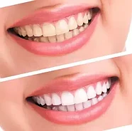 Набор для отбеливания зубов электрический Spin Smile 360 Professional Grade Tooth Polisher, фото 7