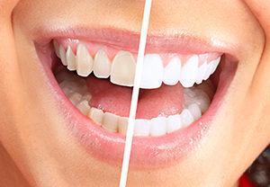 Система для отбеливания зубов 20 Minute Dental White - фото 5 - id-p111420130