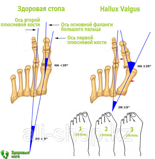 Шина от Халюс Вальгус - Hallux Valgus - фото 4 - id-p113462676