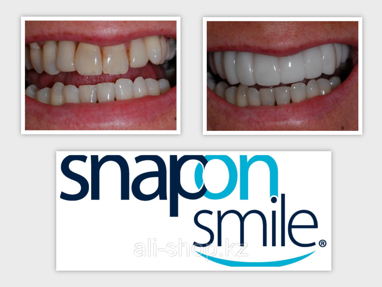 Виниры для эстетического протезирования зубов Snap On Smile - фото 4 - id-p113465197